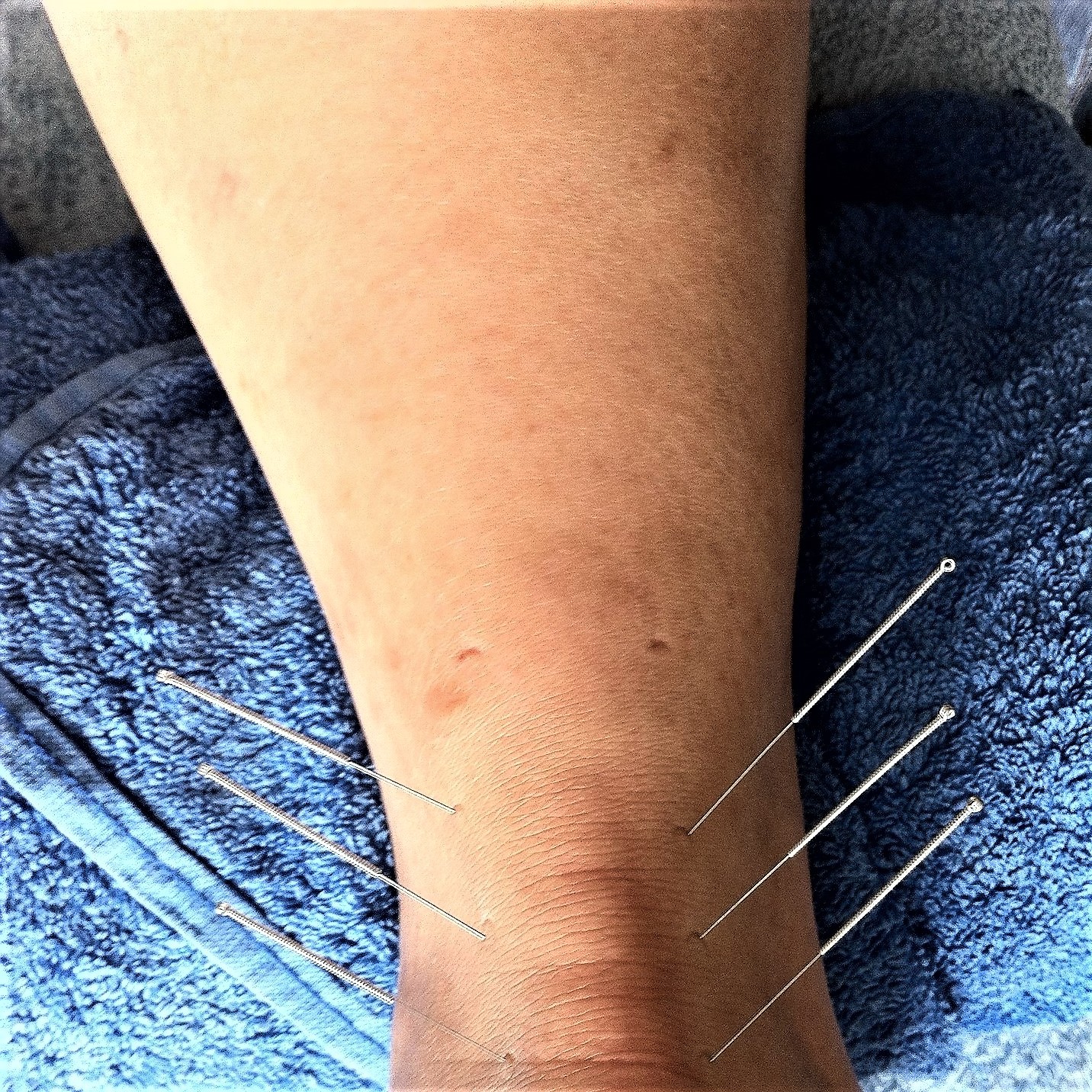 dry needling